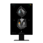 Lunit's AI-Powered Mammography Rivals Radiologists in Breast Cancer Detection