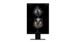 Lunit's AI-Powered Mammography Rivals Radiologists in Breast Cancer Detection