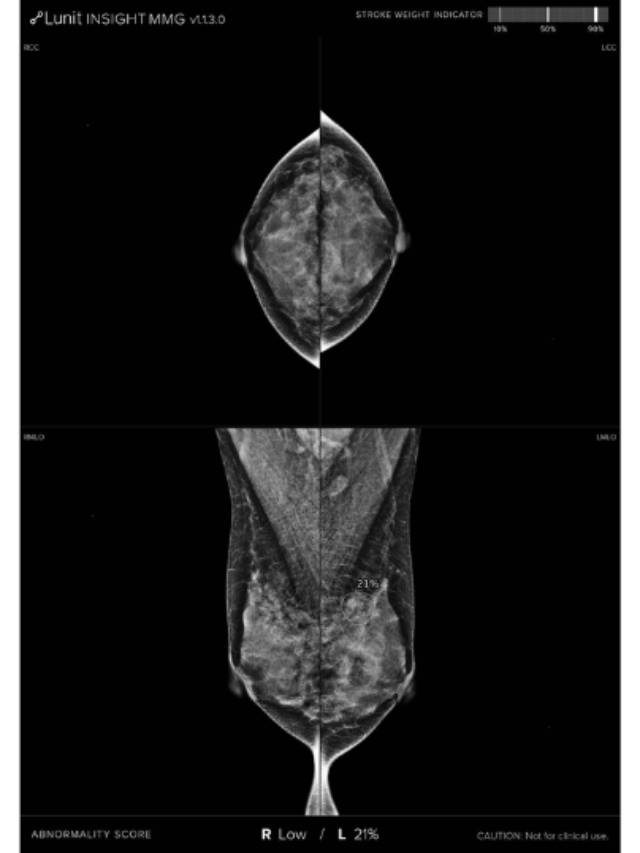 Lunit's AI-Powered Mammography Rivals Radiologists In Breast Cancer ...