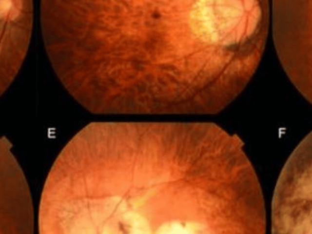 Myopia Treatment