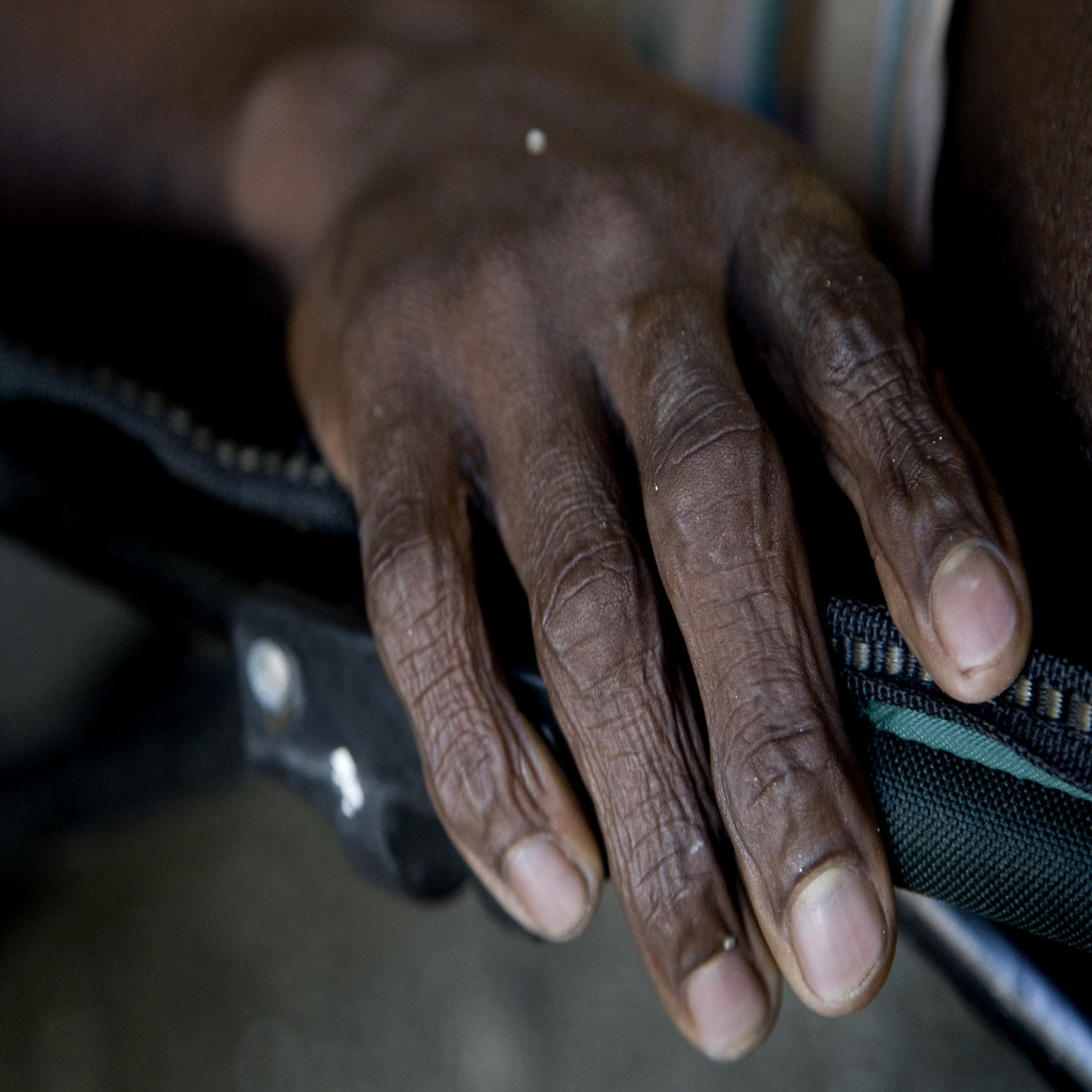 A cholera-infected patient lays on a bed at the hospital in L'Estere, 20 km north of Saint Marc, Haiti.