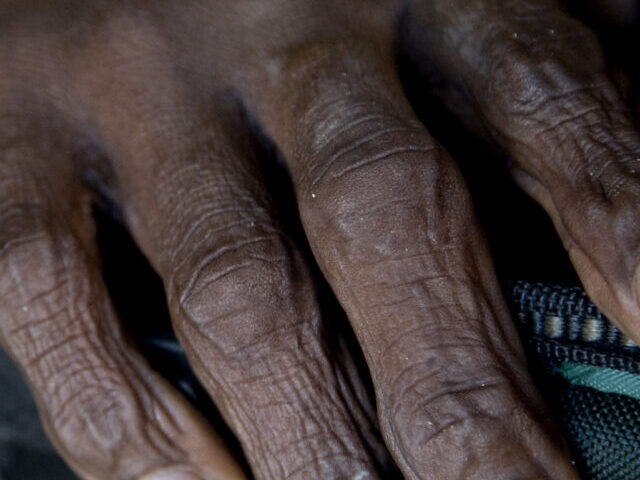 A cholera-infected patient lays on a bed at the hospital in L'Estere, 20 km north of Saint Marc, Haiti.