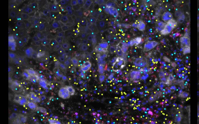 Image of an inflammatory liver disease, which often occurs at the same time as IBD, with ETS2 target genes (yellow and cyan) expressed at the site of liver damage. Credit: Christina Stankey.