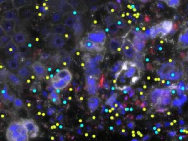 Image of an inflammatory liver disease, which often occurs at the same time as IBD, with ETS2 target genes (yellow and cyan) expressed at the site of liver damage. Credit: Christina Stankey.