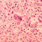 Reprentative Image. Histopathology of measles pneumonia. Photo Source: Dr. Edwin P. Ewing, Jr.