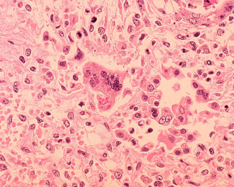 Reprentative Image. Histopathology of measles pneumonia. Photo Source: Dr. Edwin P. Ewing, Jr.