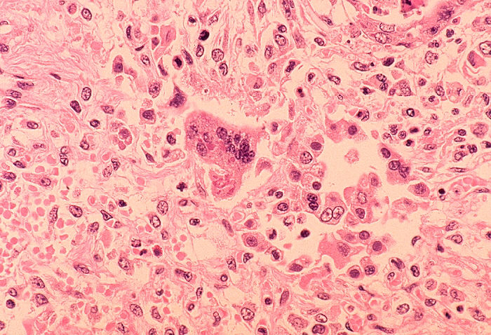 Reprentative Image. Histopathology of measles pneumonia. Photo Source: Dr. Edwin P. Ewing, Jr.