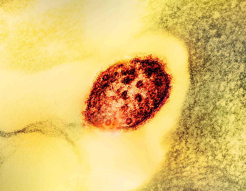 Representative Image. Measles Virus Particle. Photo Source: NIAID (CC BY 2.0)