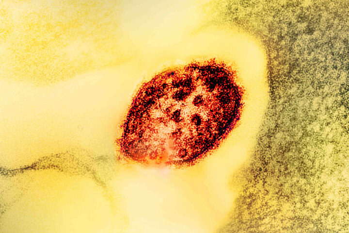 Representative Image. Measles Virus Particle. Photo Source: NIAID (CC BY 2.0)