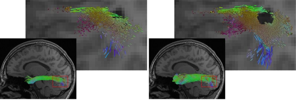 Reconstruction of the longitudinal inferior fasciculus - The illustration shows a reconstruction of the longitudinal inferior fasciculus (a fibre tract of the brain), on the left using a conventional AI method, on the right using the new hybrid approach. The hybrid approach enables a more complete reconstruction. At the same time, it more precisely omits lesions such as the dark region in the detailed view.