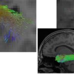 Reconstruction of the longitudinal inferior fasciculus - The illustration shows a reconstruction of the longitudinal inferior fasciculus (a fibre tract of the brain), on the left using a conventional AI method, on the right using the new hybrid approach. The hybrid approach enables a more complete reconstruction. At the same time, it more precisely omits lesions such as the dark region in the detailed view.