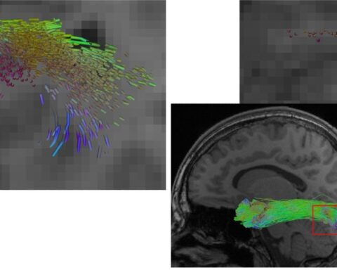 Reconstruction of the longitudinal inferior fasciculus - The illustration shows a reconstruction of the longitudinal inferior fasciculus (a fibre tract of the brain), on the left using a conventional AI method, on the right using the new hybrid approach. The hybrid approach enables a more complete reconstruction. At the same time, it more precisely omits lesions such as the dark region in the detailed view. Photo Source: University of Bonn