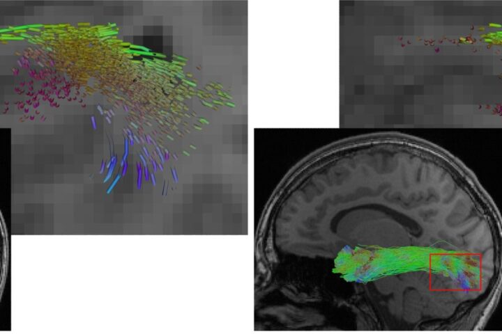 Reconstruction of the longitudinal inferior fasciculus - The illustration shows a reconstruction of the longitudinal inferior fasciculus (a fibre tract of the brain), on the left using a conventional AI method, on the right using the new hybrid approach. The hybrid approach enables a more complete reconstruction. At the same time, it more precisely omits lesions such as the dark region in the detailed view.