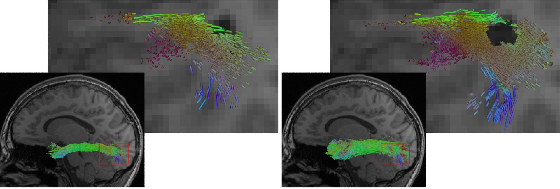 Reconstruction of the longitudinal inferior fasciculus - The illustration shows a reconstruction of the longitudinal inferior fasciculus (a fibre tract of the brain), on the left using a conventional AI method, on the right using the new hybrid approach. The hybrid approach enables a more complete reconstruction. At the same time, it more precisely omits lesions such as the dark region in the detailed view.