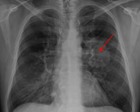 Lung cancer as seen on CXR. Photo source: Doc James (CC BY-SA 3.0)