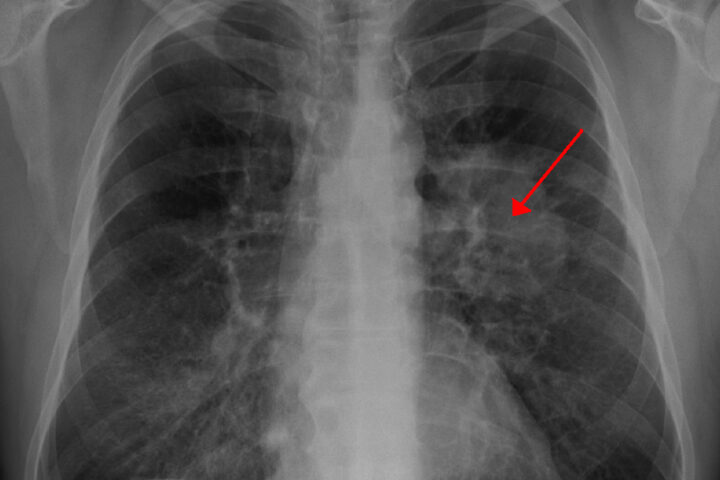 Lung cancer as seen on CXR. Photo source: Doc James (CC BY-SA 3.0)