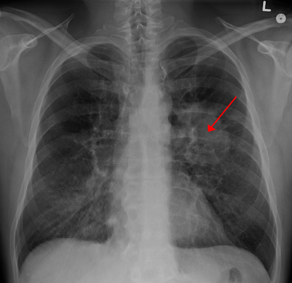 Lung cancer as seen on CXR. Photo source: Doc James (CC BY-SA 3.0)