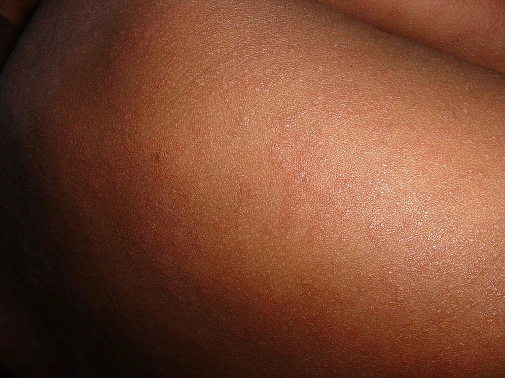 A close up of a person's butt with no shirt on. Measles virus infection.