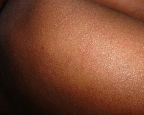 A close up of a person's skin with acne on it. Photo Source - Picryl (CCO 1.0)