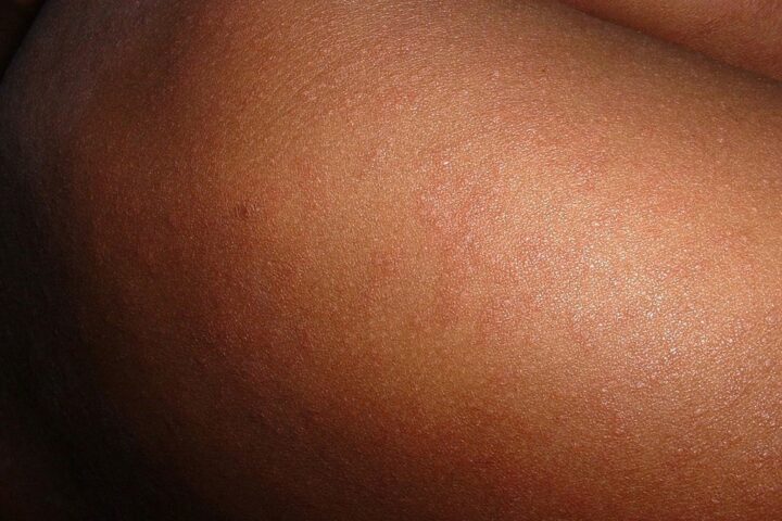 A close up of a person's skin with acne on it. Photo Source - Picryl (CCO 1.0)