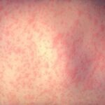 Representative Image: The skin of a patient after 3 days of measles infection.