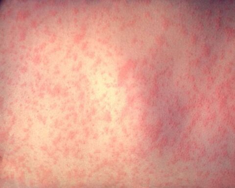 Representative Image: The skin of a patient after 3 days of measles infection.