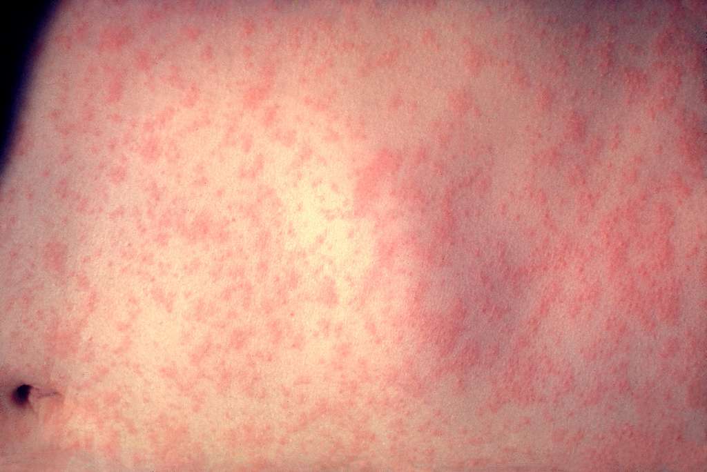 Representative Image: The skin of a patient after 3 days of measles infection.